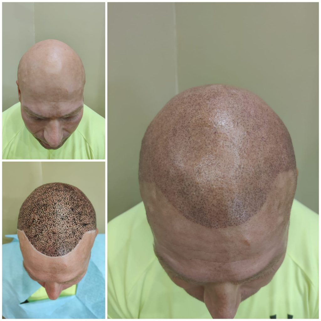 päänahan pigmentointi